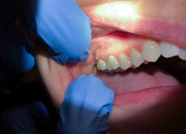 Best Dentist for Tooth Abscess  in Enoch, UT